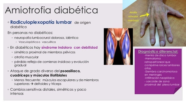amiotrofia diabetica